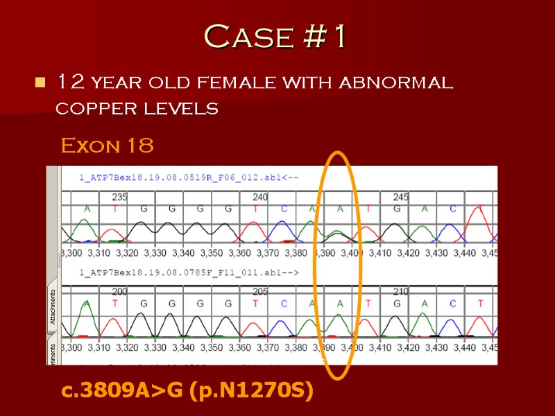 Case #1 12 year old female with abnormal copper levels Exon 18 c.3809A>G (p.N1270S)